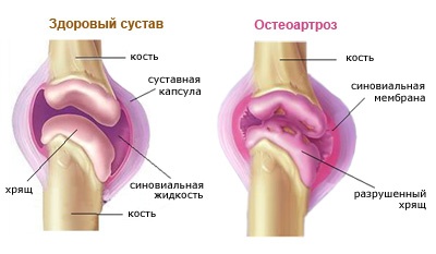 osteoartroz